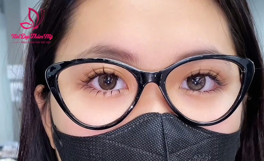 bị cận có nên nối mi