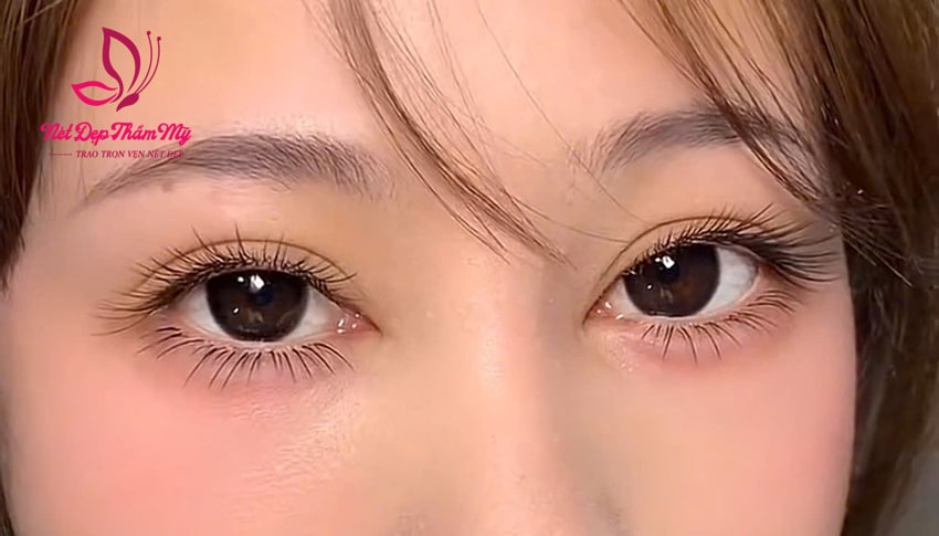 hậu quả của việc nối mi