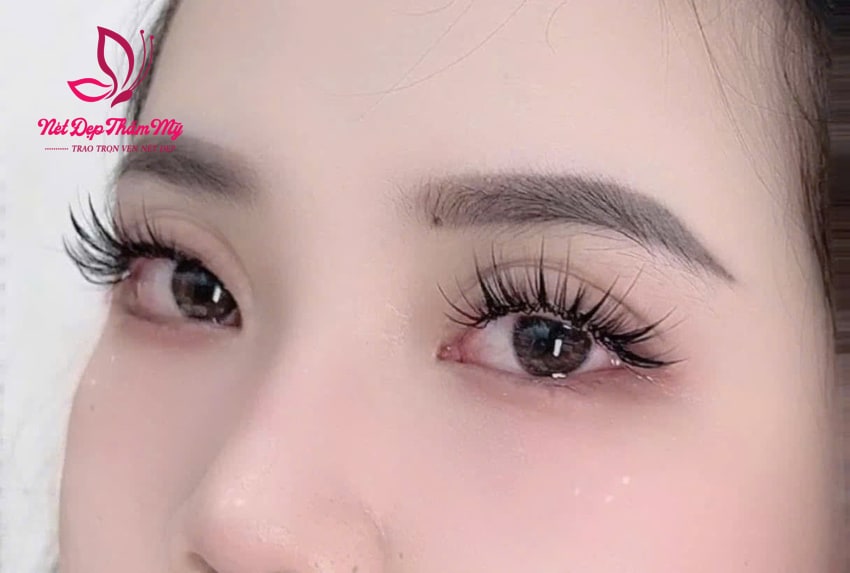 ngứa nối mi