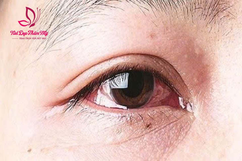 nối mi bị sưng mắt